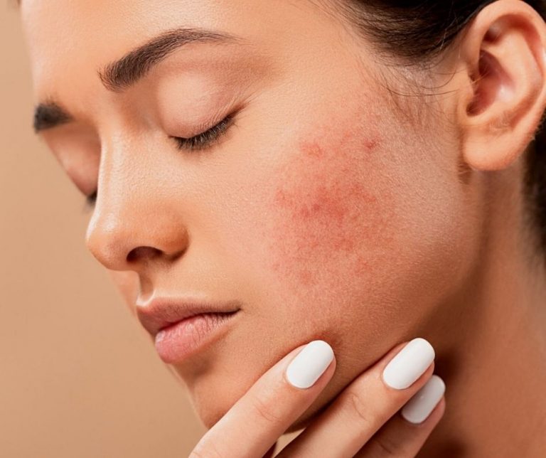 cicatrices-y-marcas-post-acne-con-anesi-t3-1