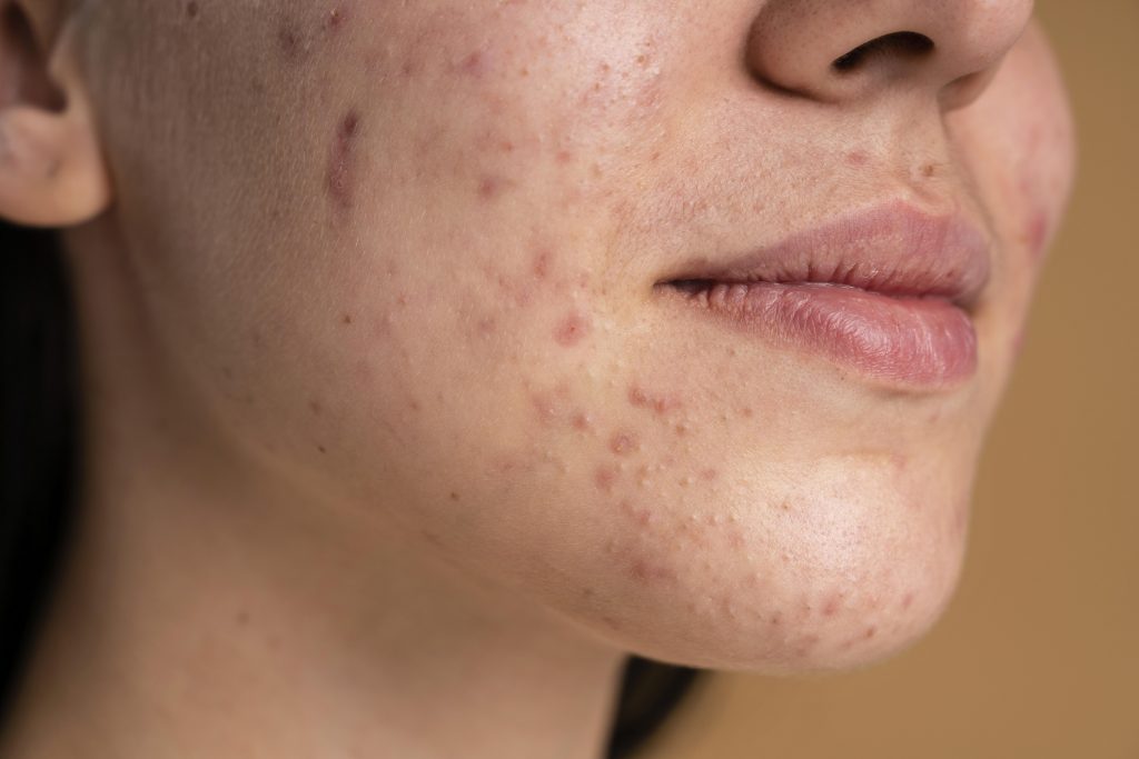 dermia solution: acne